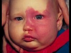 1. A port wine stain (characterized by a facial capillary malformation along the ophthalmic branch of the trigeminal nerve) and an associated leptomeningeal capillary-venous malformation (leptomeningeal angioma)


2. Seizures, mental retardation, ...