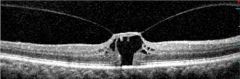 Determine the stage of this macular hole: