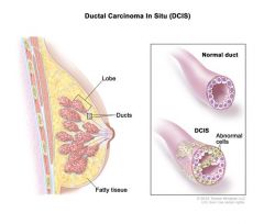Ductual carcinoma in situ (DCIS)