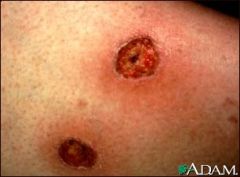 lesions of the skin or mucous membrane that evolve into nodular patches marked by hemorrhage, ulceration, and necrosis; not pathognomonic for Pseudomonas.  Also seen in neutropenic pts