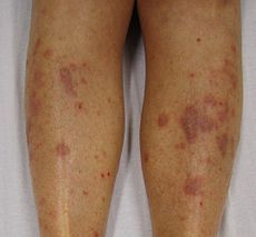 1. Hep C
2. Involves skin, nails, mucous membranes of the mouth and ext genitalia; shiny discrete itchy polygonal violaceous papules on flexural surfaces with a characteristic whitish lacy pattern; immunologically mediated
