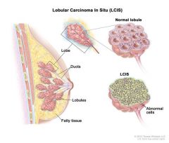 is an uncommon condition in which abnormal cells form in the lobules or milk glands in the breast. LCIS isn't cancer. But being diagnosed with LCIS indicates that you have an increased risk of developing breast cancer.