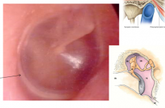 3 layers
outer-- keratinizing epithelial cells
middle-- fibrous
inner-- non keratinizing squamous mucosal cells, continuous with inner ear mucosa


should be clear and relaxed
2 parts:
pars tensa-- vibrates with sound
pars flaccida-- notch of rivi...