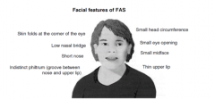 Symptoms: CNS dysfunction 
Impairment in attention, learning, memory, problem­solving, and emotional
management
Pre­natal and post­natal growth deficiency
Cluster of facial abnormalities (flat midface, short upturned nose, poorly defined
...