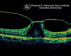 - bright posterior hyaloid tenting up the fovea & surrounding area


- perifoveal vitreous detachment