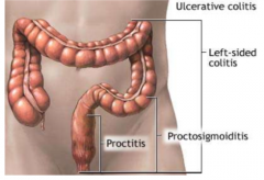 Colitis up to the hepatic flexure