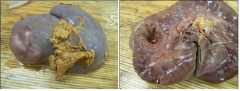 There is a 4 cm diameter tan to pink firm, cavitated, umbilicated and well delineated nodule in the left kidney.
MDx? DDx?