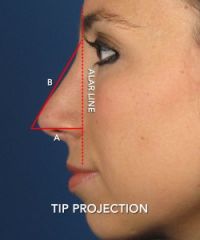 aka nasal tip projection - the degree to which the nasal tip extends from the plane of the face

The ratio of “A” to “B” is then measured and used to assess the nasal tip projection. A normal range for this ratio is 0.55-0.60 in most rhi...