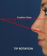 aka nasal tip rotation - the degree to which the nasal tip extends from the plane of the face (Frankfort plane)