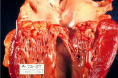 What is this? Describe.What is the valve? How do you know?

Calcific aortic stenosis
Infective endocarditis
Libman-sacks endocarditis
Nonbacterial thrombotic endocarditis