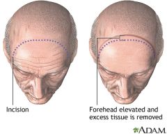 Performed similarly to the coronal forehead lift, but the incision is placed either just inferior to the hairline (pretrichial lift) in a forehead crease, or 2mm posterior to the hairline (trichophytic lift), tapering into the hairline laterally. ...