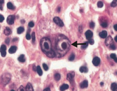Reed-Sternberg cell
- Distinctive tumor giant cell seen in Hodgkin Lymphoma
- Binucleate or bilobed with the 2 halves as mirror images ("owl eyes")