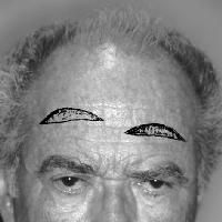 Performed through an incision made along existing horizontal rhytids in the midforehead. 
The incision can either course in one rhytid, or a Z-plasty into an adjacent rhytid at both lateral aspects can be employed for further camouflage and to pr...