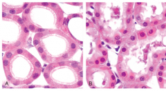 a morphology that develops with cellular swelling- small, clear vacuoles within the cytoplasm; these represent distended and pinched-off segments of the ER.