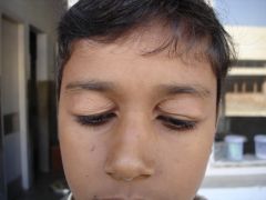 Uncommon condition involving recurrent episodes of marked eyelid edema, ultimately resulting in atrophic, thinned eyelid skin
