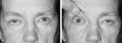 Unilateral ptosis with contralateral lid retraction. 

In patients with unilateral ptosis, if you cover the ptotic eye for 30 minutes, the retracted eye will settle into the normal position. This is because the contralateral lid demonstrates com...
