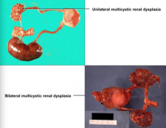 - Unilateral Multicystic Renal Dysplasia
- Bilateral Multicystic Renal Dysplasia (fatal)