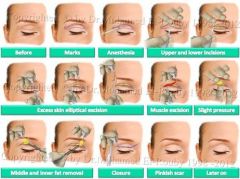1) Begin with skin markings: the lower marking is made at the superior border of the tarsal plate, in the naturally formed skin crease, 7-10 mm from the lash line.
2) At the midpupillary line, a caliper is used to mark a point 8-10mm superior to ...