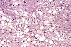 Steaosis- the appearance of lipid vacuoles in the cytoplasm.

happens in cells participating in fat metabolism (e.g., hepatocytes and myocardial cells)
