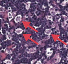 Burkitt Lymphoma
- Associated with "starry sky" appearance: sheets of lymphocytes with interspersed macrophages (arrows/stars)