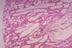 What does this histologically represent?