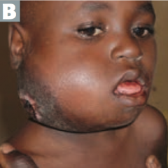 - Associated with EBV
- Jaw lesions in endemic form in Africa
- Pelvis or abdomen tumors in sporadic form