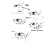 Performed through a subciliary incision 2mm to 3mm below lash line
Extends from 1mm lateral to inferior punctum to 8mm to 10mm lateral to lateral canthus
Retention suture placed for retraction, skin-muscle flap raised to level of orbital rim, an...