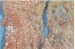 caused by the release of lipases into fatty tissue, resultng in lysis of trglycerides to FA's which are then saponified by calcium producing visible FOCAL chalky white areas