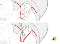 The standard procedure involves elevation of anterior (temporal and preauricular) and posterior (postauricular and cervical) skin flaps. 
The incision is made from the temporal region, takes advantage of the preauricular crease, extends around th...