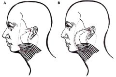 dissection extends medial to the parotid and can even extend to the upper lip.