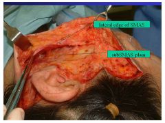 Sub-SMAS plane in laterally transitioning to a supra-SMAS plane in the superior-medial cheek directly on the anterior surface of the zygomaticus major and minor muscles
Because these muscles are innervated from their deep surfaces, the risk of fa...