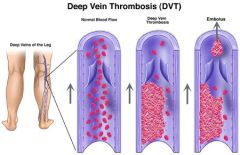 - "economic class syndrome"
- blood clot (thrombosis) forming in a deep vein 
- causing blood to accumulate in the vein of the lower body 
- usually during resting 
blood pool and decrease flow rate due to immobility in the vein 
venous thrombosis
