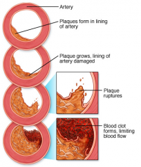 - it is the formation of "plague", fatty substance lining the inner wall of arteries. 
- narrowing the artery, affecting blood flow 
- often later cause the accumulation of "thrombus", blood clots, due to rupture of plague 
- endothelial cells are...