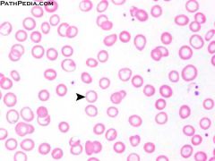 Which type of anemia?