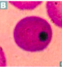 In  mothballs. 
Causes functional hyposplenia and the presence of Howell-Jolly bodies seen in RBC smear.