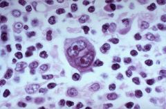 A 66 y/o male presented with a low grade fever, night sweats, weight loss, and nontender LAD which felt firm and rubbery. 

A biopsy was taken of a lymph node, and the above histology was noted. 

What is the diagnosis, and how does it spread ...
