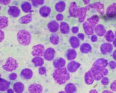 Diffuse large B cell lymphoma. 

t(14:18) in 20% of cases.