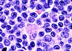 Mantle cell lymphoma.