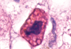 cytoplasm- very eosinophilic from protein breakdown. there are also apoptotic bodies.

nucleus- karyorrhexis from getting the DNA ready to be packaged into proteonucleosomes