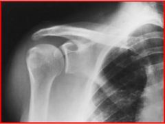 On this xray, where is the lateral border of the scapula? What else can you ID?