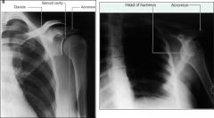 What sort of motion can cause this xray on the right?