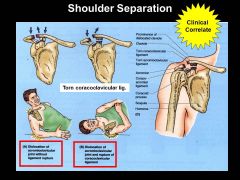 in shoulder separation, articulation between ACROMION and CLAVICLE are compromised
