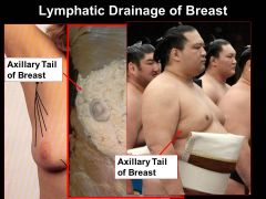 Why do you need to be really careful when removing lymph nodes for breast cancer surgery?