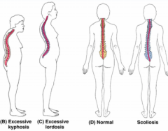 -Kyphosis: exaggerated rounding of the back
-Lordosis: exaggerated inward curving of the back
-Scoliosis: sideways curvature of the spine