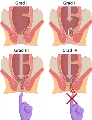 Grad I: lokale Vergrößerung
Grad II: prolabieren bei Bauchpresse, spontane Reposition
Grad III: prolabieren bei Bauchpresse, manuell reponierbar
Grad IV: beständiger Prolaps