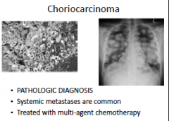 gestational choriocarcinoma 

#146