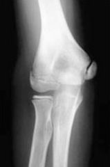 Hx:10yo little league pitcher has the triad of med elbow pain in his throwing arm, dec throwing effectiveness, dec throwing distance. What is the pathogenesis of the condition occuring? 1- Acute frag of capitellar ossific nucleus; 2-Rupture of the...