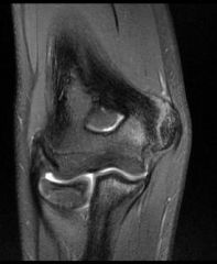Little League elbow = repetitive valgus stresses & tension overload of the med structures, repetitive contraction of the flexor-pronator mass stresses the chondro-osseous origin at the medial epicondyle, leading to inflammation and subsequent apop...