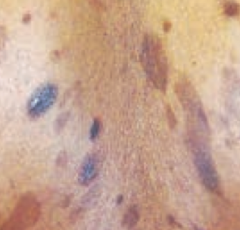 What lymphoma presents with cutaneous patches / plaques / tumors? What kind of cells?