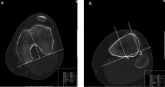 lat patellar tilt and lateral facet compression synd, respectively. lateral retinacular release is the most appropriate tx, surgical tx for this condition is rare and used only in cases that are recalcitrant to conservative measures, TT-TG distanc...